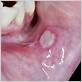 gum disease mouth ulcers