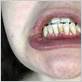 gum disease mumsnet