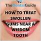 gum disease near wisdom teeth