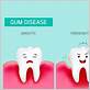 gum disease newmarket
