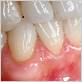 gum disease north vancouver bc