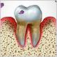 gum disease p gingivalis