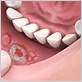 gum disease painful ulcers