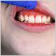 gum disease phototherapy