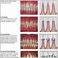 gum disease pictures a comprehensive view
