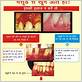 gum disease pictures in hindi