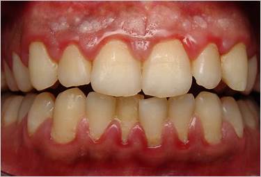 gum disease pittsburgh