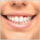 gum disease port charlotte fl