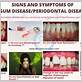 gum disease pyrea