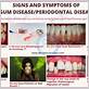 gum disease pyria symptoms