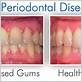 gum disease quora