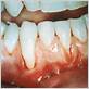 gum disease rheumatoid arthritis