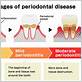 gum disease rio grande city tx