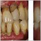 gum disease romford