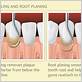 gum disease root planing