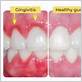 gum disease san angelo tx