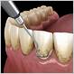 gum disease scaling and planing