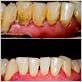gum disease scaling before and after images