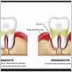 gum disease severna park