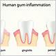 gum disease spread by kissing