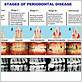 gum disease stages chart