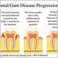 gum disease surgery cost in india