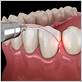 gum disease surgery savannah