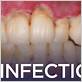 gum disease symptom hiv