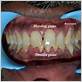 gum disease symptoms black