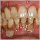 gum disease tartar buld up