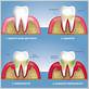 gum disease teeth pain