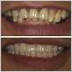 gum disease teeth removal