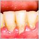 gum disease that cause gums receding