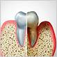 gum disease that destroys bone