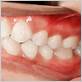 gum disease the villages fl