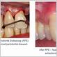 gum disease therapy cost