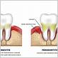 gum disease therapy kanata