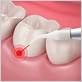gum disease therapy memphis