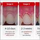 gum disease timeline