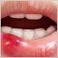 gum disease tingling lips