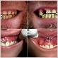 gum disease tongue piercing