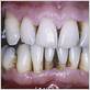 gum disease tra