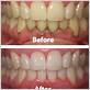 gum disease treatment before and after pictures