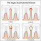 gum disease treatment bel air md