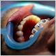 gum disease treatment braces