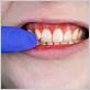 gum disease treatment campsie