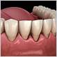 gum disease treatment canyon country