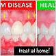 gum disease treatment cost in india