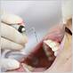 gum disease treatment dental hygienist