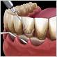 gum disease treatment dentures